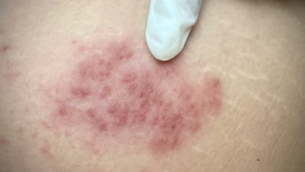 La vacuna contra el herpes z&oacute;ster podr&iacute;a reducir el riesgo de demencia en personas mayores