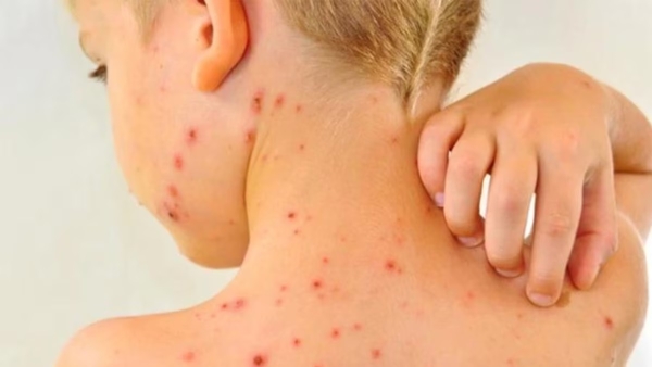 Ante el aumento de casos de sarampi&oacute;n, el Gobierno anunci&oacute; una estrategia focalizada de vacunaci&oacute;n