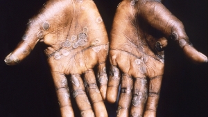 Confirmaron la primera muerte por mpox (viruela s&iacute;mica) en la Argentina