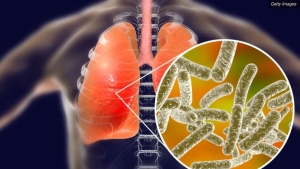 Qu&eacute; es la Legionella, c&oacute;mo se transmite y por qu&eacute; puede provocar enfermedad mortal