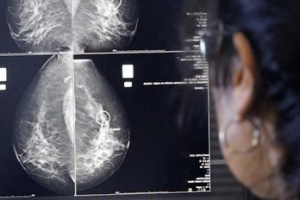 La detecci&oacute;n temprana de c&aacute;ncer de mama posibilita curaci&oacute;n en 9 de cada 10 casos