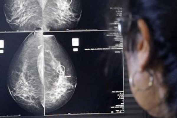 La detecci&oacute;n temprana de c&aacute;ncer de mama posibilita curaci&oacute;n en 9 de cada 10 casos