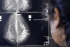 La detecci&oacute;n temprana de c&aacute;ncer de mama posibilita curaci&oacute;n en 9 de cada 10 casos